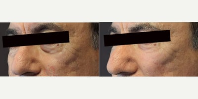 55-64 year old man treated with Juvederm, Volbella, Voluma, Restylane, Restylane Contour - 4D Under Eye Lift - Treatment of dark circles & bags under eyes and cheek restoration with Belotero, Restylane, Volbella and Voluma