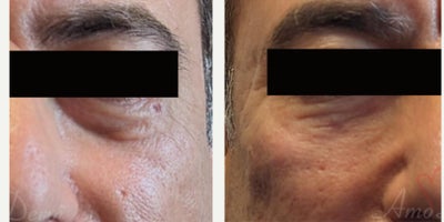 55-64 year old man treated with Juvederm, Volbella, Voluma, Restylane, Restylane Contour - 4D Under Eye Lift - Treatment of dark circles & bags under eyes and cheek restoration with Belotero, Restylane, Volbella and Voluma