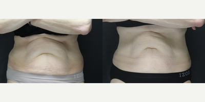 45-54 year old woman treated with Vanquish - Vanquish Fat Removal after 6 treatments