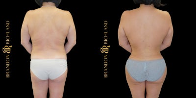 35-44 year old woman treated with Mommy Makeover, Breast Implant Revision, Tummy Tuck, Liposuction, Renuvion, Brazilian Butt Lif - A 3544-year-old woman underwent a customized Mommy Makeover that included breast implant revision, tummy tuck, liposuction, Renuvion skin tightening, and a Brazilian Butt Lift. The procedure enhanced breast shape and symmetry while sculpting the abdomen, waist, and curves for a more balanced, contoured figure. The patient is extremely happy with her results and loves the natural-looking transformation and renewed confidence in her body.