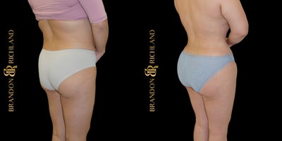 35-44 year old woman treated with Mommy Makeover, Breast Implant Revision, Tummy Tuck, Liposuction, Renuvion, Brazilian Butt Lif - A 3544-year-old woman underwent a customized Mommy Makeover that included breast implant revision, tummy tuck, liposuction, Renuvion skin tightening, and a Brazilian Butt Lift. The procedure enhanced breast shape and symmetry while sculpting the abdomen, waist, and curves for a more balanced, contoured figure. The patient is extremely happy with her results and loves the natural-looking transformation and renewed confidence in her body.