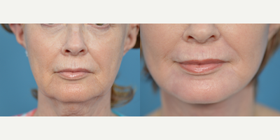 65-74 year old woman treated with Dermabrasion - This patient was concerned with the lines around her mouth. A dermabrasion procedure around her mouth was performed to address her concerns with excellent results.
