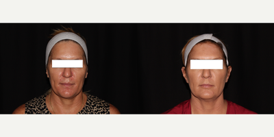 35-44 year old woman treated with Silhouette InstaLift - After a topical numbing cream is applied to the face, Dr. V threads absorbable sutures with Sculptra-infused cones through the cheeks. Once engaged with the skin, the cones snap into place for immediate volume and lift. FDA-approved Sculptra Aesthetic is an injectable that works to correct shallow to deep facial wrinkles and folds by stimulating and replacing skin's own collagen production, which can help provide a refined, more youthful looking appearance.