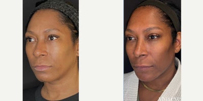 Full Face Balancing and Rejuvenation - 40 year old female wanted to look her best for her upcoming birthday. Aligning with her goals and budget, we treated her with hyaluronic acid dermal fillers and neuromodulators (Botox and Dysport) for her beautiful result.Cheek balancing, chin filler, jawline filler, lip filler, and upper face Botox