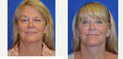 55-64 year old woman treated with Laser Treatment - This patient came in wanting to look as young as she feels. Wanting a natural-looking result, she reached out to Dr. Ho for more information on how to improve her appearance. She elected to have a face/neck lift, fat transfer and laser skin resurfacing procedure.