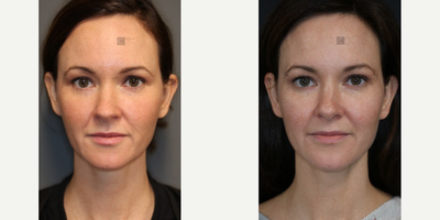 Woman treated with Bellafill - Woman treated with Bellafill