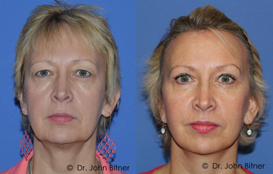 Brow Lift -
Brow Lift