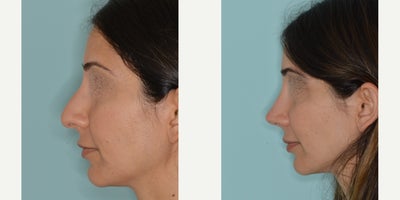 35-44 year old woman treated with Rhinoplasty - Before and after primary rhinoplasty for a patient with a challenging case of a crooked nose and dorsal hump. Techniques to straighten the crooked nose included medial and lateral osteotomies, ultrasonic rhinoplasty hump reduction, clocking sutures, and tip support with caudal extension graft.