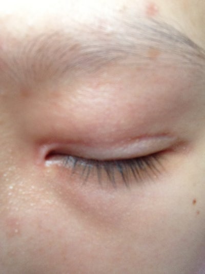 East Asian Eyelid Anatomy, Lacking Socket Line? (photo) Doctor Answers