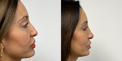 45-54 year old woman treated with Rhinoplasty - Two weeks after a rhinoplasty