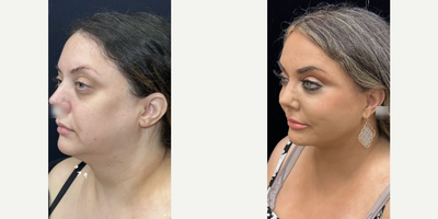Woman treated with Deep Plane Facelift, Neck Lift, Buccal Fat Removal, Facial Fat Transfer - Woman treated with Deep Plane Facelift, Neck Lift, Buccal Fat Removal, Facial Fat Transfer