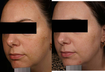 Melasma - Melasma before and after 1 treatment with the long pulsed alexandrite, 755 nm laser - GentleLase.