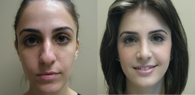 25 year old female Rhinoplasty - Rhinoplasty