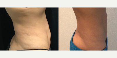 Woman treated with CoolTone - Woman treated with CoolTone