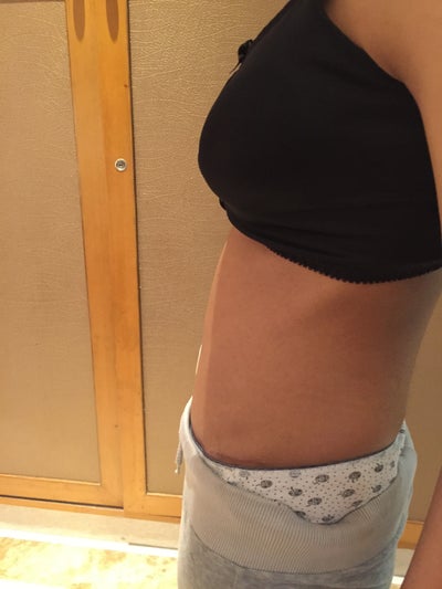 bulge-in-upper-abdomen-7-weeks-post-tummy-tuck-any-suggestions