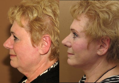 Neck lift -
Neck lift associated with midfacelift and blepharoplasty