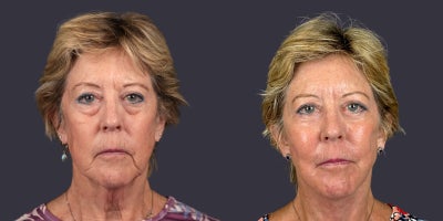 65-74 year old woman treated with Facelift, Eyelid Surgery, CO2 Laser, Skin Rejuvenation, Lower Facelift, Neck Lift, SMAS Faceli - This 68 year old woman is 5'2 and 129 pounds. She presented requesting facial rejuvenation. She had a deep plane - SMAS facelift and neck lift, lower eyelid blepharoplasty, corner of the mouth lift, and central face skin rejuvenation with CO2 laser resurfacing.