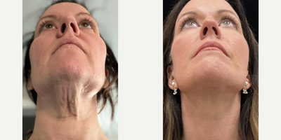 44 year old woman treated with Deep Plane Facelift, Neck Lift, Facial Fat Transfer - 44 year old woman treated with Deep Plane Facelift, Neck Lift, Facial Fat Transfer