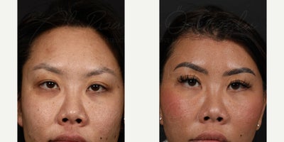 25-34 year old woman treated with Forehead Reduction - A middle-aged female patient underwent forehead reduction. The images show her natural-looking results at 17 days postoperatively, with improved facial balance and rejuvenation.