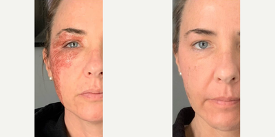 35-44 year old woman treated with PlasmaPen - Female treated with Plasma MD Pen shown immediately after procedure and eight days-post procedure. Plasma Pen is used to tighten, improve skin laxity, and reduce wrinkles.