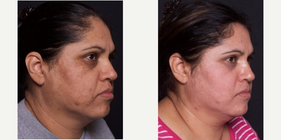 45-54 year old woman treated with Chemical Peel - Patient came in wanting to correct her uneven pigmentation. After consulting with our aesthetician, she elected to have the Melanage Mask Peel.