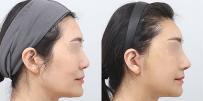 45-54 year old woman treated with AccuLift, Mini Facelift - This before-and-after photo showcases the results of a comprehensive facial contouring and rejuvenation procedure. Accu jawline and double chin contouring refined the lower face, while forehead and front cheek enhancement restored youthful volume. Nasolabial fold correction softened smile lines for a smoother appearance.A Mini Face Lift with Endotine fixation, along with lateral and lower lifting techniques, improved facial sagging and definition. Eye revision surgery further enhanced symmetry, resulting in a naturally lifted, balanced, and refreshed look.