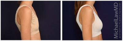 25-34 year old woman treated with Mentor Breast Implants - Breast augmentation. Follow-up photos taken 3 months after the procedure.