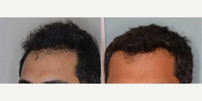 Man treated with FUE Hair Transplant - Before and after 1200 FUE grafts to reinforce and lower the hairline.