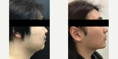 Man treated with Exilis - Exilis and Filler for chin and jawline