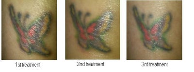How Much Fading Should I Expect After Three Laser Tattoo ...