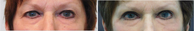 69 year old woman treated with Upper Eyelid Lift - This lovely woman presented to our Center with concerns of heavy upper eyelids. She stated that she wanted to better see the permanent eyeliner that she had recently applied. She was also requesting that the asymmetry (a.k.a. unevenness) she had be addressed to make her droopier right eye better match her left side. In the comfort of our Center we safely performed an upper eyelid blepharoplasty under local anesthesia and mild oral sedation with valium. We removed slightly more skin on her right side to help make her eyes appear more even afterwards. Her recovery time was under one week, and sutures were removed on day #5.
