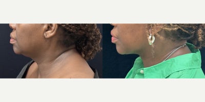 65 year old woman treated with Deep Plane Facelift, Neck Lift - 65 year old woman treated with Deep Plane Facelift, Neck Lift