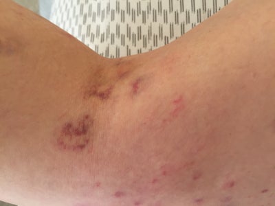 sclerotherapy veins treatment spider wasn successful mean does