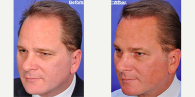 Man treated with Hair Loss Treatment - Man treated with Hair Loss Treatment throughSmartGraft