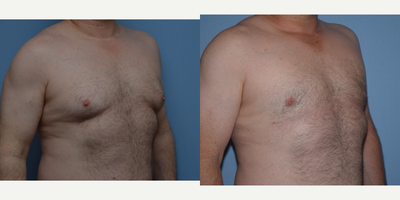 45-54 year old man treated with Male Breast Reduction - This 49-year-old man came for a consultation with Dr. Romanelli to discuss Gynecomastia, or male breast reduction. Enlargement of the male breast known as gynecomastia is most often a combination of both glandular tissue and extra fatty tissue. Dr. Romanelli performed both liposuction and a surgical excision of this excess tissue to achieve his desired results. The patient surgery took about two hours, he wore a surgical vest for about 10 days and required just a small amount of pain medication. His postoperative photographs show a great improvement.
