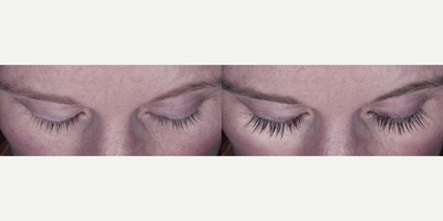 Woman treated with Eyebrow Transplant - Woman treated with Eyebrow Transplant