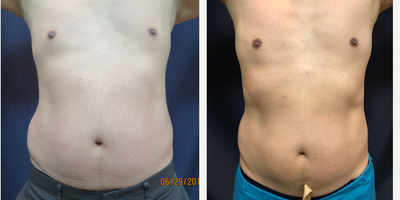 45-54 year old man treated with SculpSure - 8 weeks after two treatments with Sculpsure to abdomen and right flank. Right flank is bigger due to Paradoxical Adipose Hyperplasia after Coolsculpting. Two treatments to the area of PAH did significantly reduce the enlargement from the PAH.