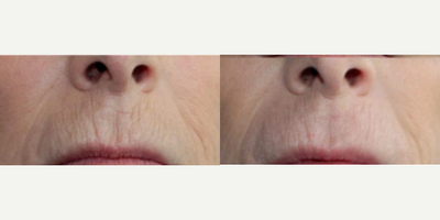 Woman treated with PlasmaPen - Woman treated with PlasmaPen
