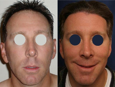 Man treated with Hair Transplant - Man treated with Hair Transplant withFleming/Mayer Flap