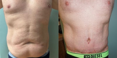 55-64 year old man treated with Male Tummy Tuck - This patient had extended tummy tuck with flank liposuction