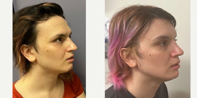 25-34 year old woman treated with Forehead Reduction, Brow Lift, Brow Bone Reduction, Rhinoplasty, Lip Surgery, Genioplasty, Fac - This lady underwent forehead feminization, feminizing rhinoplasty, chin feminization and lip augmentation.