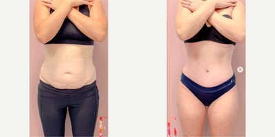 35-44 year old woman treated with Tummy Tuck - 35-44 year old woman treated with Tummy Tuck