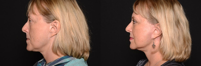 Woman treated with Eyelid Surgery - Patient over 60 wanted to refresh her look and get rid of her under-eye-bags.