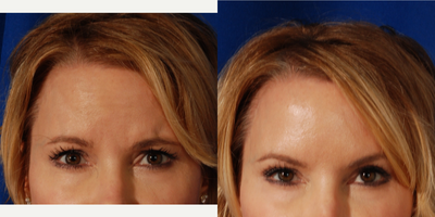 35-44 year old woman treated with Botox - Botox to the Glabella region relaxes the muscle activity for a smooth appearance.
