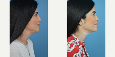 45-54 year old woman treated with Ultherapy - 48 year old female with laxity in the neck area.