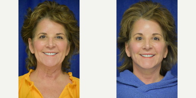 671 65-74 year old woman treated with Lower Facelift, Facelift, Brow Lift, Chemical Peel - 45-54 year old woman treated with Facelift, Neck Lift, Facial Fat Transfer, Eyelid Surgery