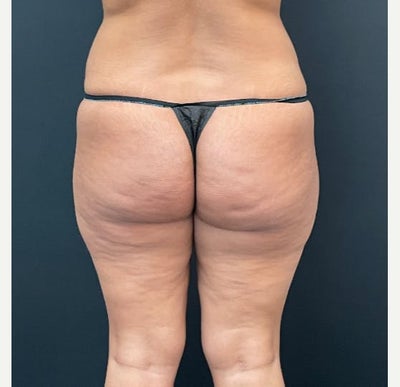 35-44 year old woman treated with Brazilian Butt Lift - Full Waist Vaser Liposuction and Buttock Fat Transfer