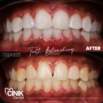25-34 year old man treated with Teeth Whitening - Teeth Whitening