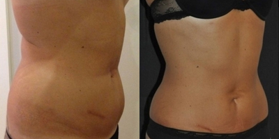 Vaser Liposuction - Patient received Vaser Liposculpture on the abdomen.
