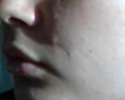 Deep facial scar